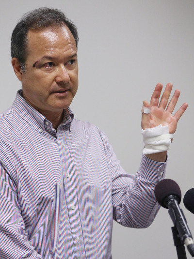 Rep Tom Brower shows his injuries to his left hand during press conference at the Capitol room 312. 30 june 2015. photograph Cory Lum/Civil Beat